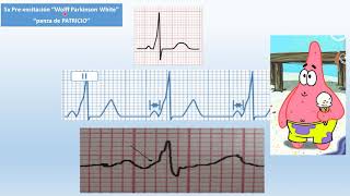 Recuerda de manera fácil los PATRONES EN ELECTROCARDIOGRAMAS [upl. by Netsrejk]