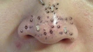 Blackhead Removal With Sac Dep Spa 1000362 [upl. by Landri]