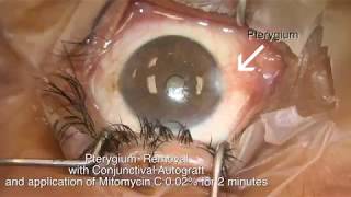 Pterygium removal with conjunctival autograft and mitomycin C Shannon Wong MD 52817 [upl. by Donalt570]