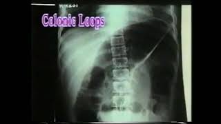 533 Colonic Obstruction  Colonic loops  Abdomen Xrays  Dr Vaidya [upl. by Raddatz]