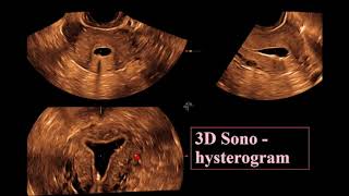 The Endometrium ultrasound [upl. by Bael483]