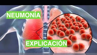 ¿Cómo se produce la Neumonía Fisiopatología de la Neumonía [upl. by Stafani148]