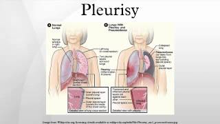 Pleurisy [upl. by Sebastien]