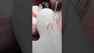 Tooth nerve dentist dental viralvideo [upl. by Anitsugua782]