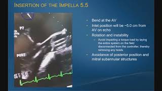 Impella 55 with SmartAssist Implantation Experience [upl. by Rehtaef]