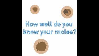 Mole or melanoma Spot the difference [upl. by Loferski]