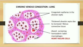 Chronic Venous CongestionLungLiverSpleen kidney [upl. by Philcox]