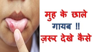 मुंह जीभ के छाले का इलाज Muh Gale Jibh Ke Chale Ka ilaj Home Remedies to Get Rid of Canker Sores [upl. by Eahs854]