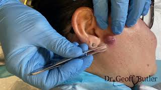 Drainage of an infected cyst in front of the ear [upl. by Riocard]