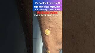 Foam Sclerotherapy for varicose veins Varicose veins treatment for SSC GD medical [upl. by Lubba]