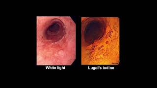 Barrets Esophagus  Clinical Features [upl. by Butterworth]