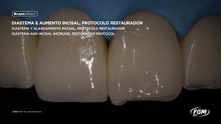 Diastema e aumento incisal com a resina Vittra APS [upl. by Metabel]