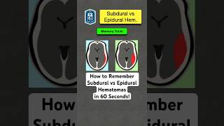 🔥 How to Remember Subdural vs Epidural Hematomas in 60 Seconds Nursing [upl. by Gauthier]