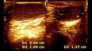 Cryptorchidism in children  Testicular Microlithiasis  Undescended testis [upl. by Kalindi]