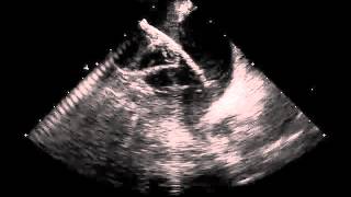 HandsOn Ablation  Video 1222 [upl. by Idoux578]