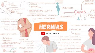 What are hernias  Direct and Indirect  MedStudier [upl. by Johannes]