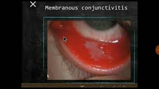 Membranous and pseudomembranous conjunctivitis conjunctiva [upl. by Reivad251]