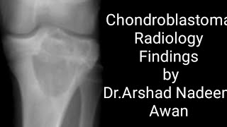 Chondroblastoma Radiology x rays and CT images [upl. by Cowan]