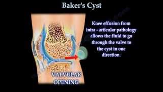 Bakers Cyst  Everything You Need To Know  Dr Nabil Ebraheim [upl. by Norrej]