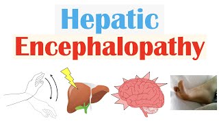 Hepatic Encephalopathy  Pathophysiology Triggers Signs amp Symptoms Diagnosis Treatment [upl. by Annavaj181]