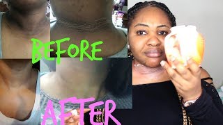 MY SKIN WHITENINGBLEACHING ROUTINE HOW TO LIGHTEN UNDERARMS amp NECK CAROWHITE REVIEW [upl. by Iredale]