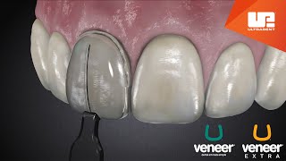 Uveneer® Procedure Animation  Direct Veneer Template System [upl. by Neened527]