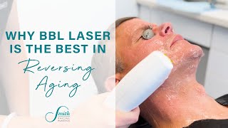 What you really need to know about the BBL Laser  Skin Rejuvenation [upl. by Mariquilla]