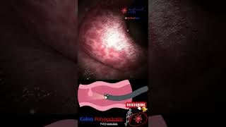 Coloscopy  Colon Polyp Resection  Polypectomy [upl. by Anitsirhc]