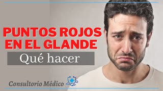 Puntos rojos en el G1ande por qué aparecen Qué hacer Candida Albicans👨‍⚕️ Consultorio Médico [upl. by Gnem426]