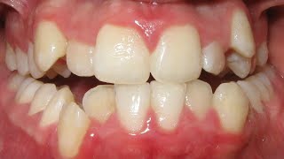 HOW BRACES WORK timelapse of extraction treatment in severe crowding case Before and After [upl. by Nevai845]