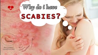 Scabies mites coming out of my skin [upl. by Hinze]