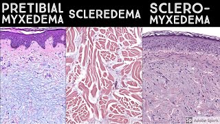 Pretibial Myxedema vs Scleredema vs Scleromyxedema  Dermatopathology quotSoundAlikesquot [upl. by Noval]