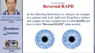 Reversed RAPD explained [upl. by Northway109]