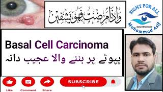 Basal Cell CarcinomaAik Ajeeb Daana [upl. by Ardnoet]