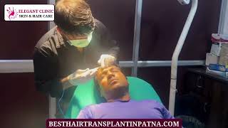 Best Mole Removal Treatment in Patna  Elegant Clinic elegantclinic [upl. by Myra477]