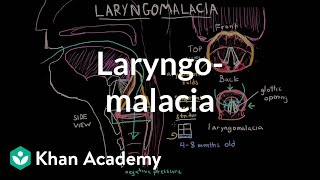 Laryngomalacia  Respiratory system diseases  NCLEXRN  Khan Academy [upl. by Gelasius]