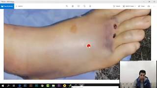 شرح كل كسور استقبال العظام فى ساعتين 3 Metatarsal Bones Fractures [upl. by Lered]