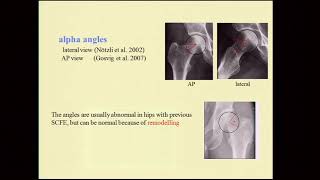 T Terjesen Prophylactic fixation of the contralateral side in SCFE Hip Symposium 2016 [upl. by Varrian]