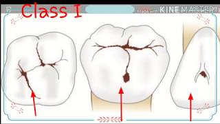 Classification of dental caries  JV Blacks Classification of dental caries [upl. by Catt]