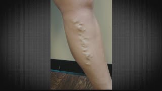 Chronic Venous Insufficiency Treatment and care [upl. by Garret]