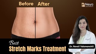 How to get rid of Stretch Marks  Stretch Marks Treatment  Stretch marks treatment in Hyderabad [upl. by Itsa997]