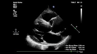 Aortic dissection echocardiography [upl. by Olds]