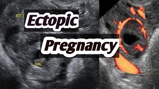 sonography of Ectopic pregnancyEctopic pregnancy in early scanUltrasound of Ectopic please [upl. by Ebert737]