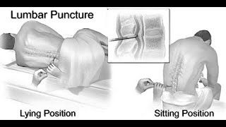 Mnemonics to remember structures pierced during Lumbar Puncture [upl. by Monto]