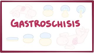 Gastroschisis  causes symptoms diagnosis treatment pathology [upl. by Tioneb86]