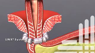 Schneck Surgical Associates  LINX Procedure [upl. by Nickerson]