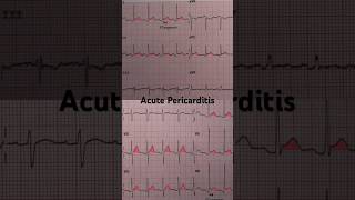 Acute Pericarditis ECG Widespread STsegment elevation [upl. by Edahs287]