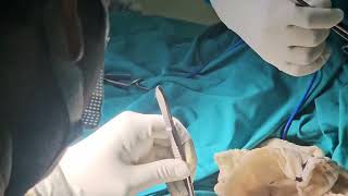 Excision of Nodular Swelling from Ligamentum Patellae [upl. by Bobbee907]