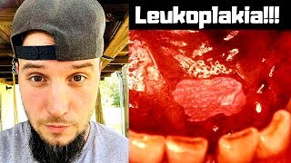 Dangers of Dipping 1 Leukoplakia [upl. by Gemperle]