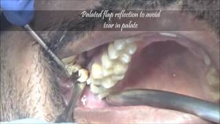 How to remove upper wisdom molar with cryer elevatorsteps [upl. by Zusman136]